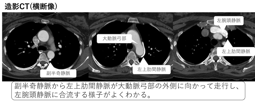 大動脈乳頭(aortic nipple)の胸部レントゲン、CT画像所見のポイント